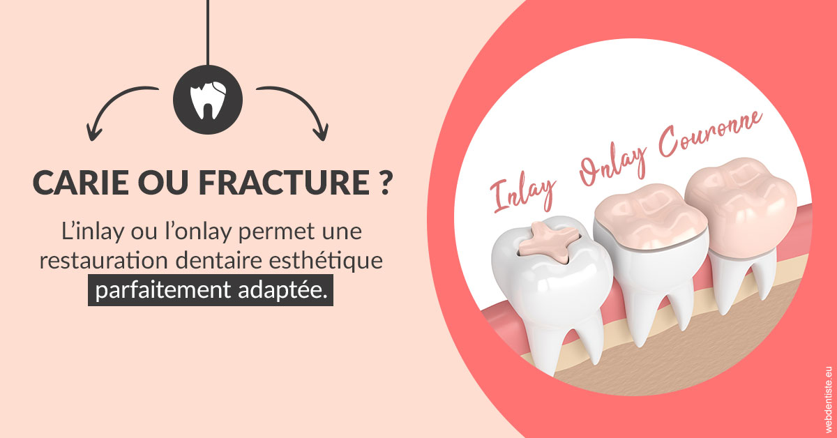 https://www.dentistes-saint-jean-centre.com/T2 2023 - Carie ou fracture 2