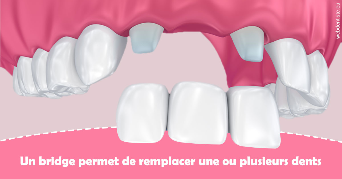 https://www.dentistes-saint-jean-centre.com/Bridge remplacer dents 2