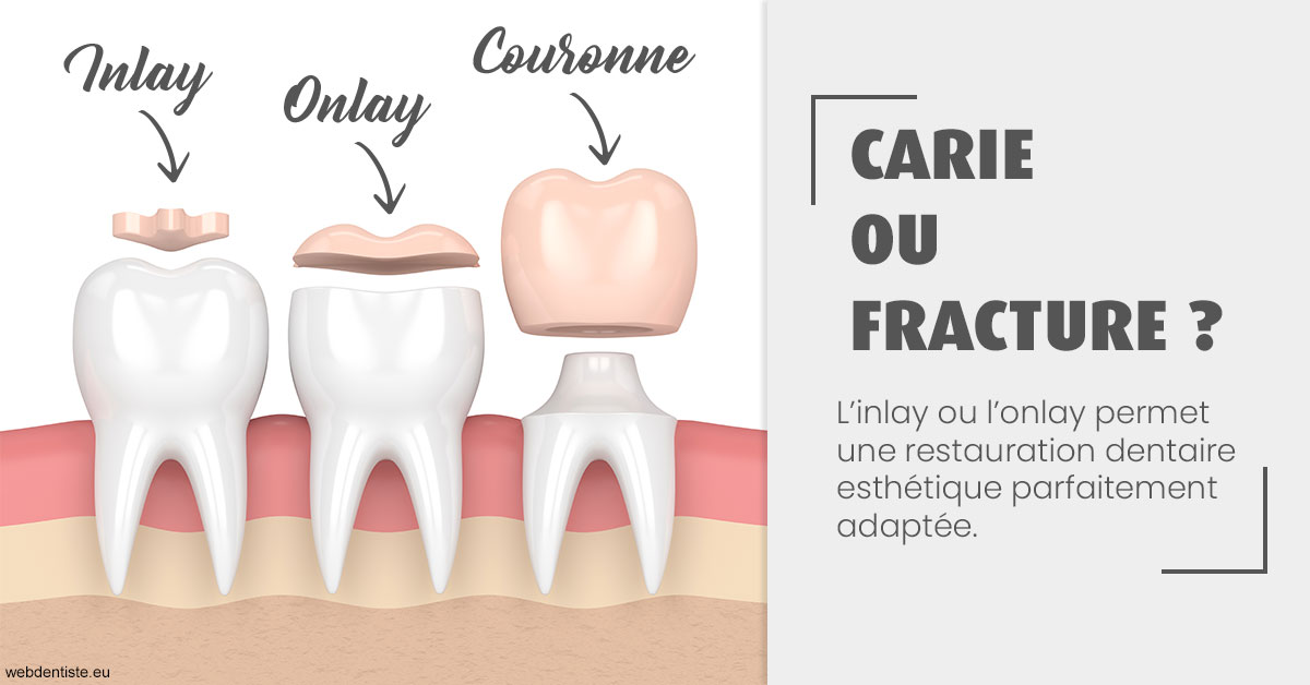 https://www.dentistes-saint-jean-centre.com/T2 2023 - Carie ou fracture 1