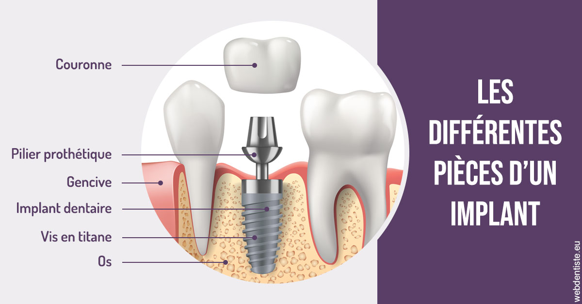 https://www.dentistes-saint-jean-centre.com/Les différentes pièces d’un implant 2