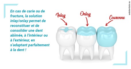 https://www.dentistes-saint-jean-centre.com/L'INLAY ou l'ONLAY