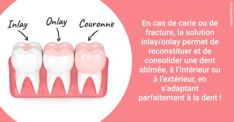 https://www.dentistes-saint-jean-centre.com/L'INLAY ou l'ONLAY 2