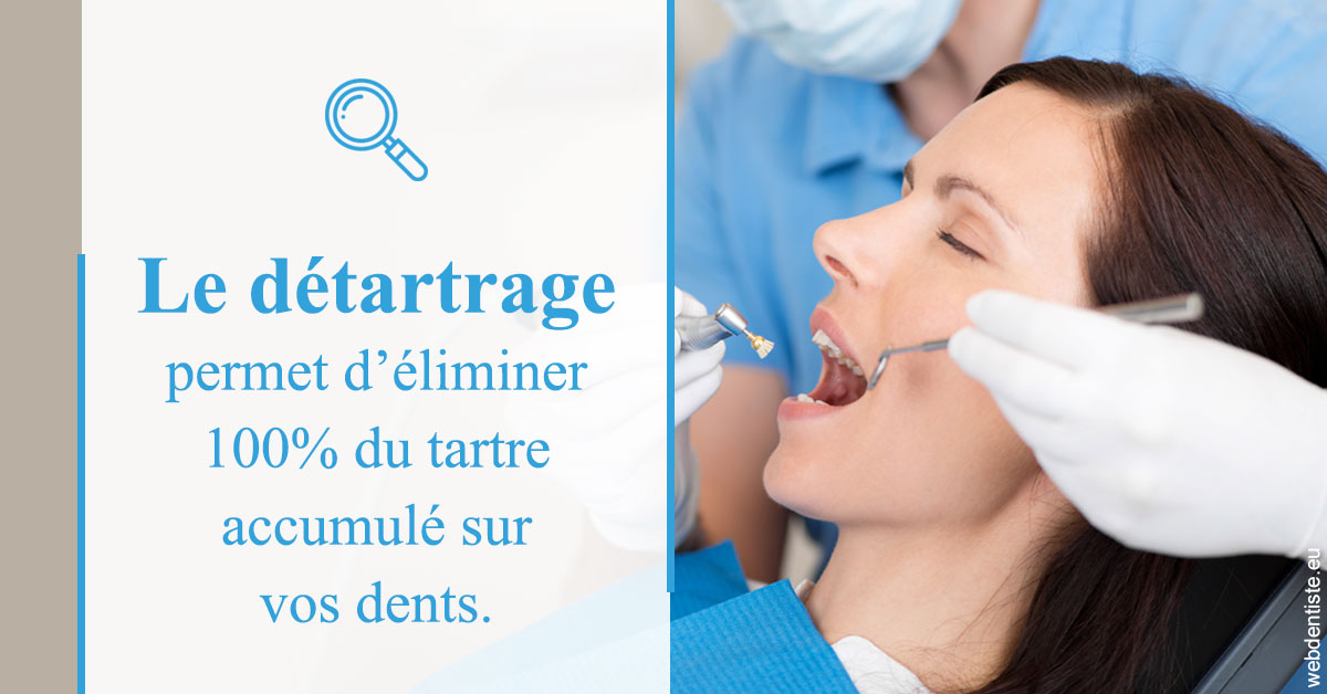 https://www.dentistes-saint-jean-centre.com/En quoi consiste le détartrage