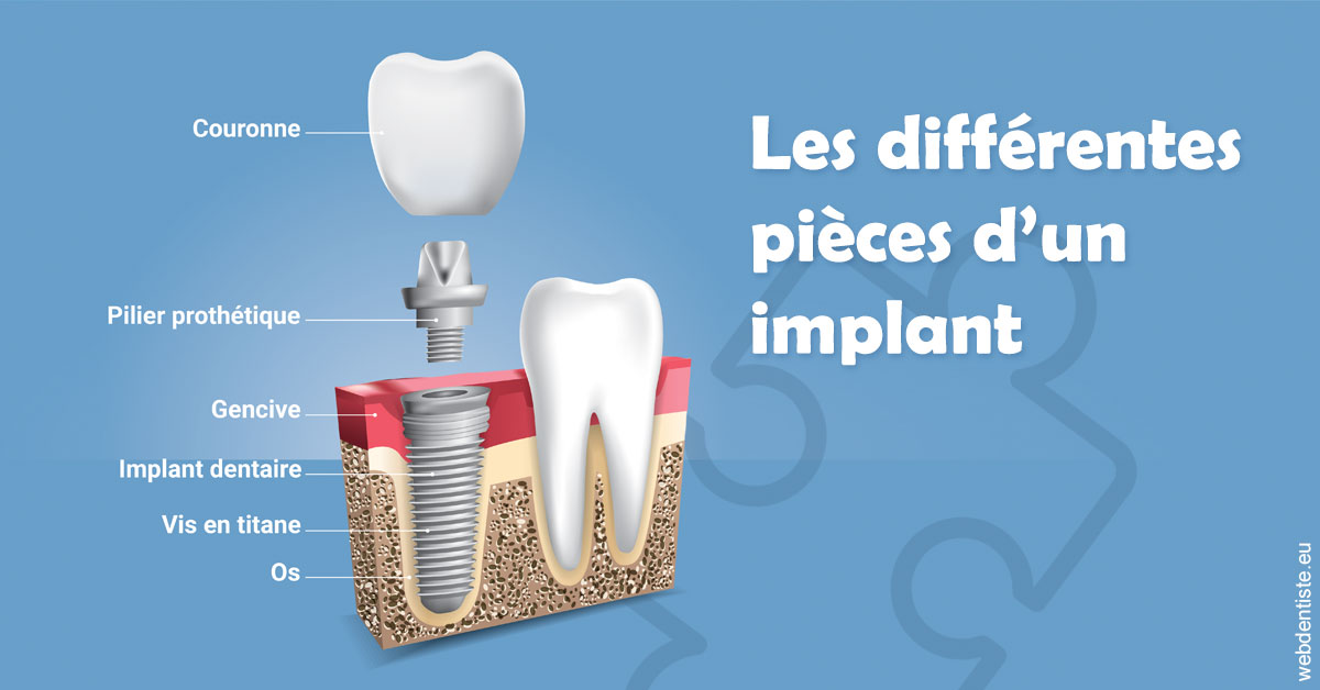 https://www.dentistes-saint-jean-centre.com/Les différentes pièces d’un implant 1